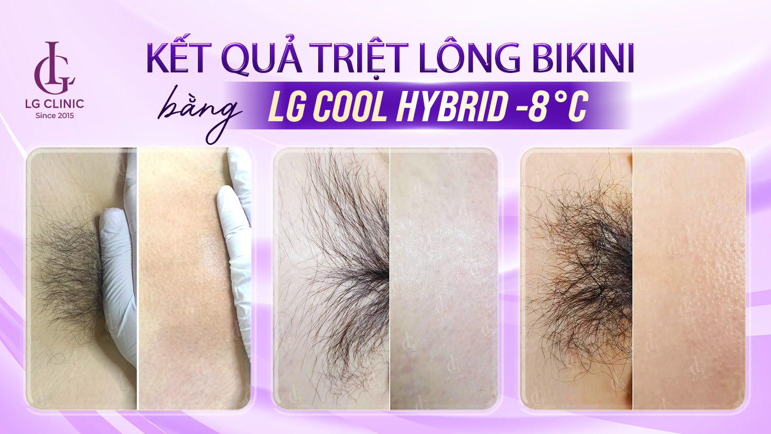 Kết quả triệt lông bikini bằng công nghệ LG Cool Hybrid