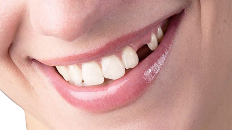 nằm mơ thấy rụng răng